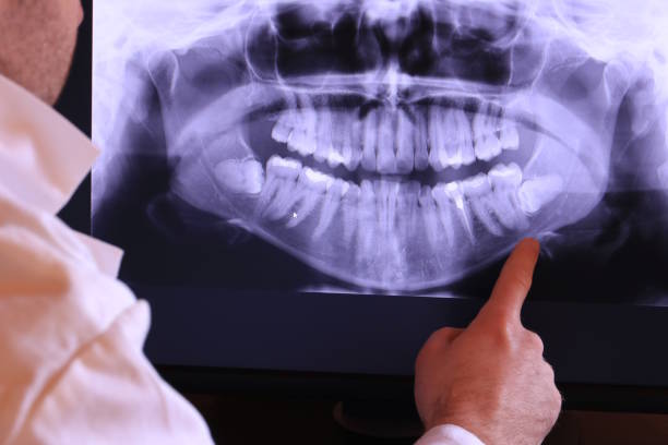 Best Emergency Root Canal Treatment in Chepachet, RI